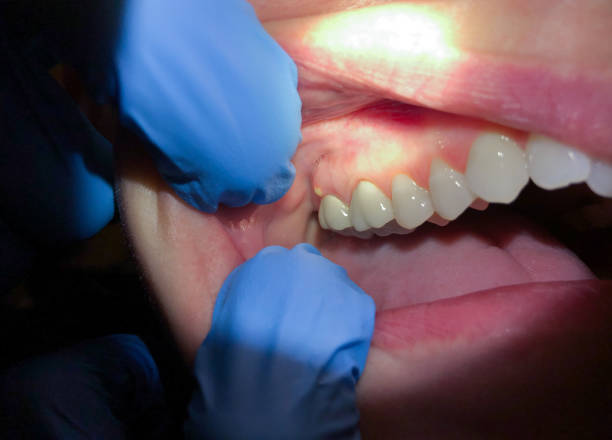Best Emergency Care for Gum Disease in Biscayne Park, FL