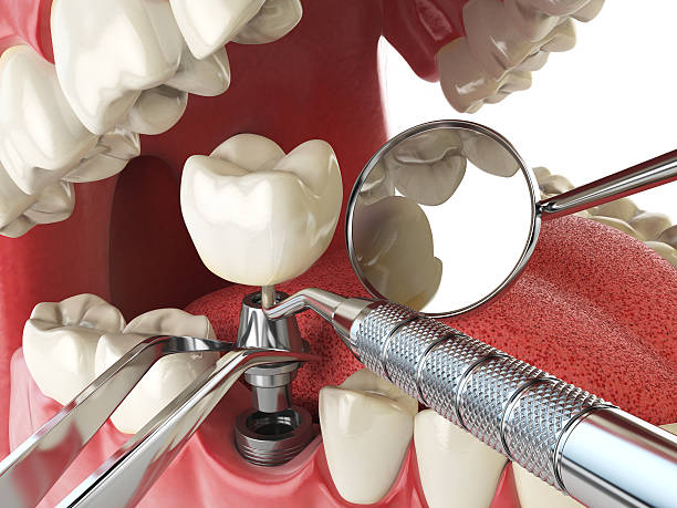 Best Knocked-Out Tooth (Avulsed Tooth) Treatment in Biscayne Park, FL