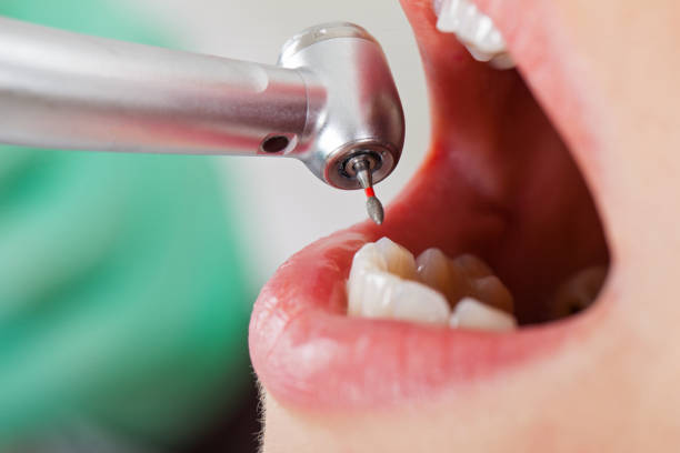 Best Broken or Chipped Tooth Repair in Biscayne Park, FL